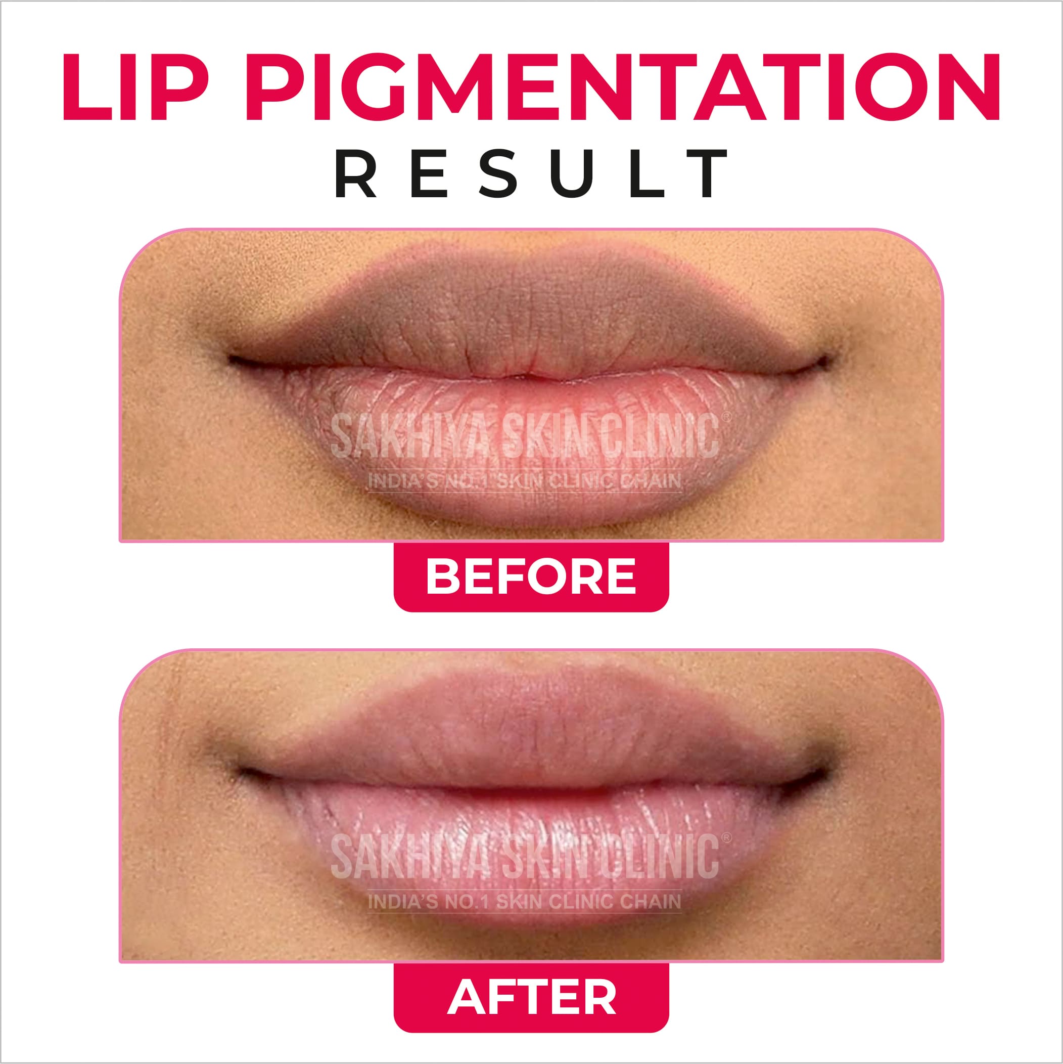 hemoglobin c black lips Pale Skin Anemia Anemia Lip Color: What Is