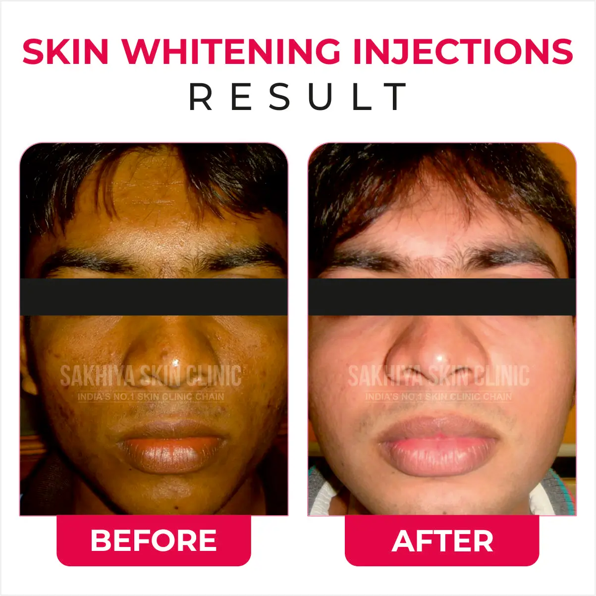 dermatologist glutathione injections 10 Best Dermatologist Recommended Skin Glow Treatments